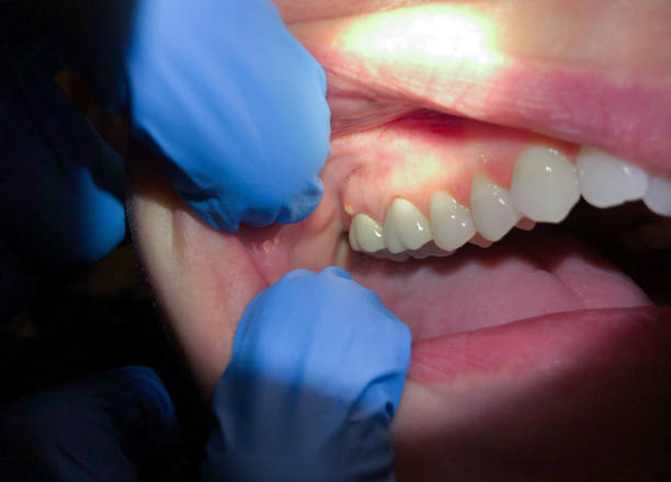Best Emergency Dentist for Knocked-Out Tooth in Celina, OH