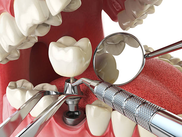 Best Emergency Dental Extractions in Celina, OH